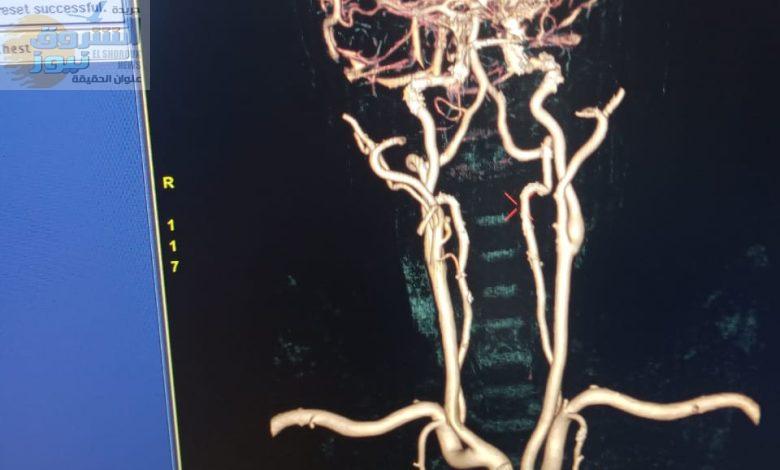 خطوة غير مسبوقة إدخال خدمة فحص شرايين المخ في مستشفى العريش العام